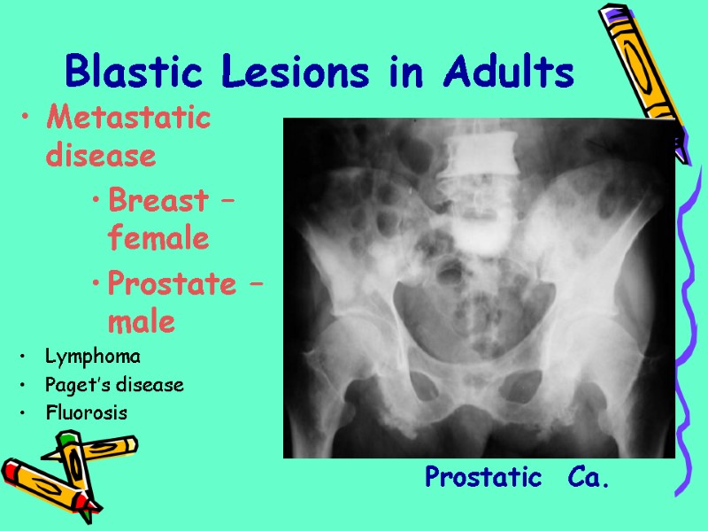 Metastatic disease Breast –female Prostate –male Lymphoma Paget’s disease Fluorosis Prostatic  Ca. Blastic